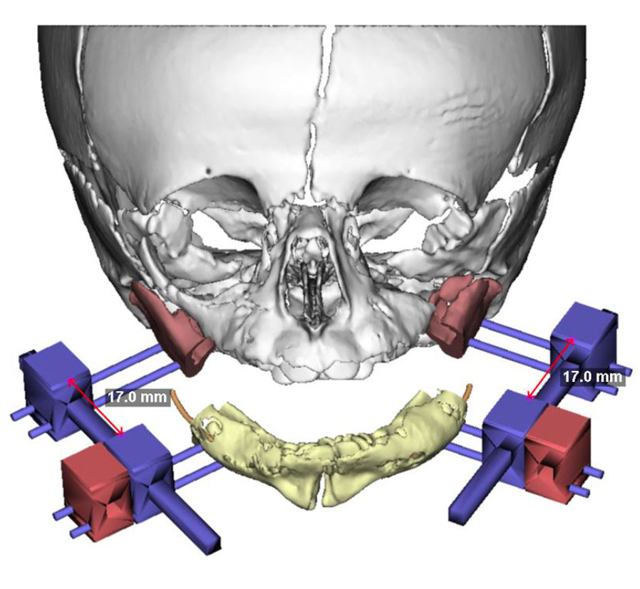 USP cria projeto que simula cirurgia craniana com impressão 3D e