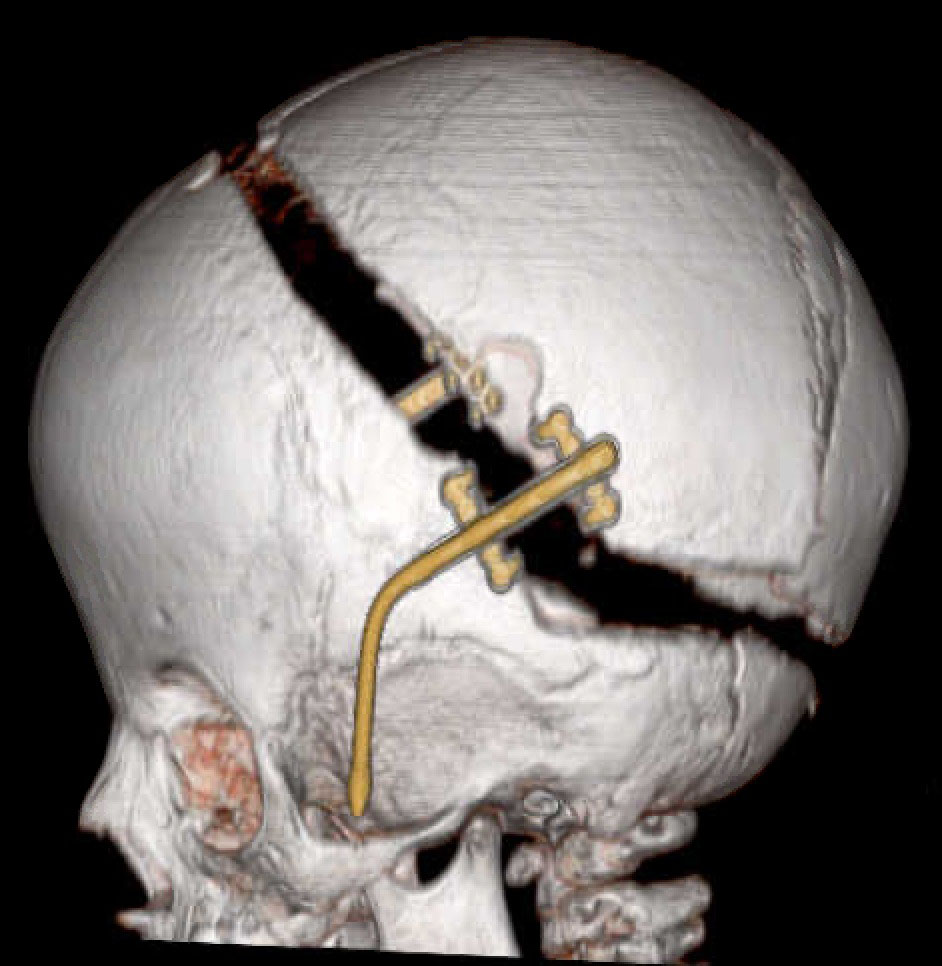 USP cria projeto que simula cirurgia craniana com impressão 3D e